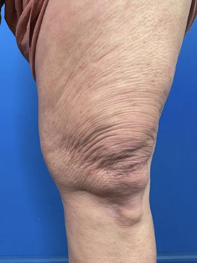 Virtue Rf Before & After Gallery - Patient 385328 - Image 1