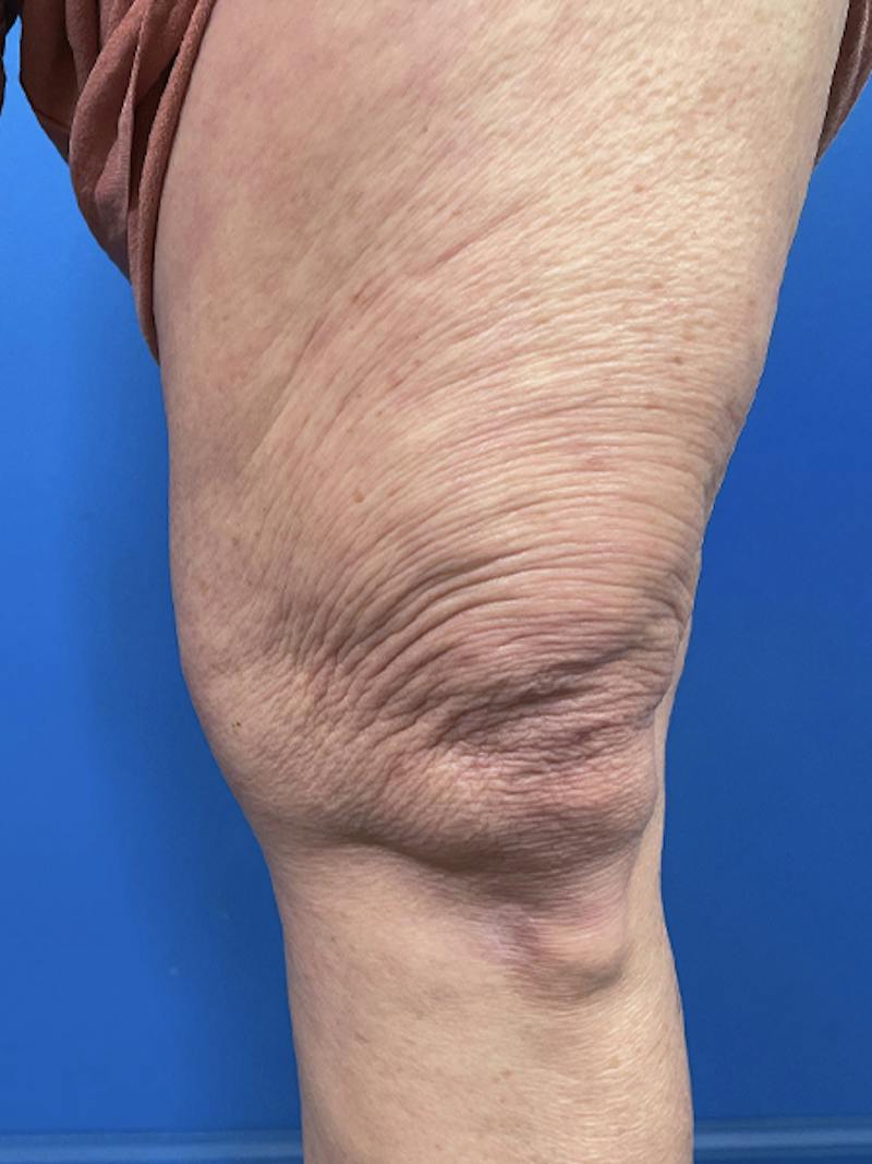 Virtue Rf Before & After Gallery - Patient 385328 - Image 1