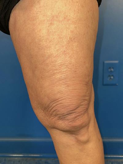 Virtue Rf Before & After Gallery - Patient 385328 - Image 2