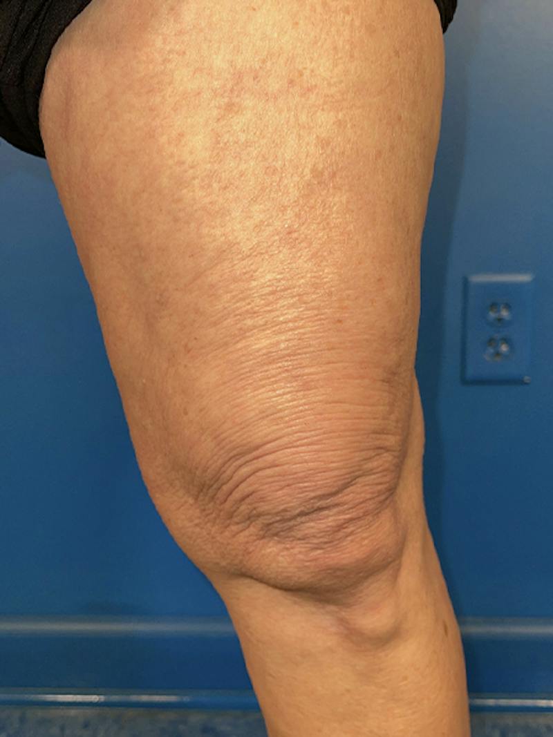 Virtue Rf Before & After Gallery - Patient 385328 - Image 2