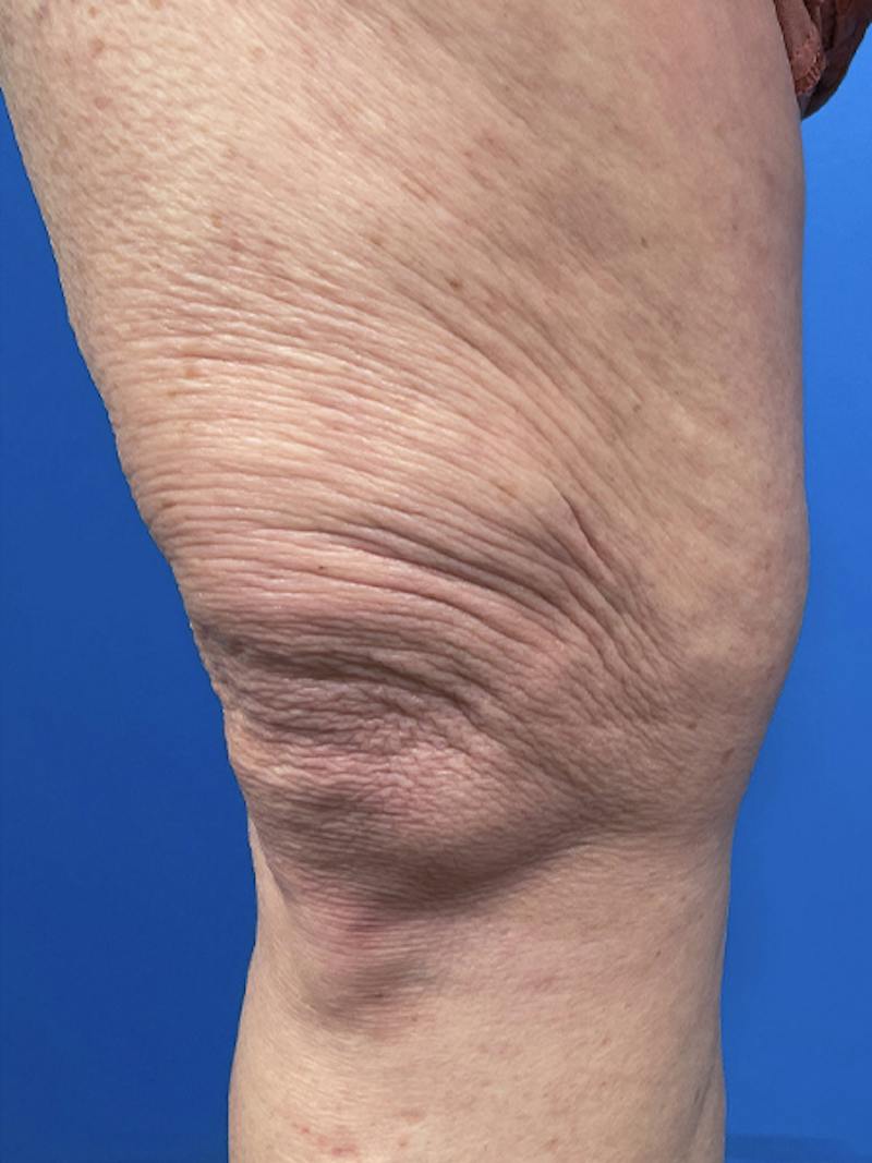 Virtue Rf Before & After Gallery - Patient 385328 - Image 3