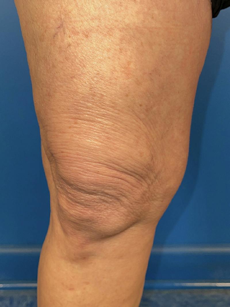 Virtue Rf Before & After Gallery - Patient 385328 - Image 4