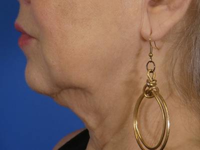 Virtue Rf Before & After Gallery - Patient 312666 - Image 1