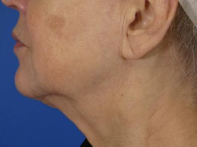 Virtue Rf Before & After Gallery - Patient 312666 - Image 2