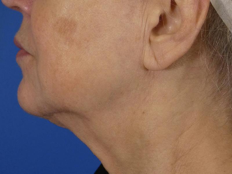 Virtue Rf Before & After Gallery - Patient 312666 - Image 2