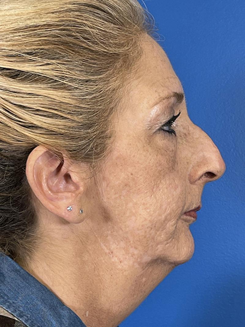 Liquid Rhinoplasty Before & After Gallery - Patient 135005 - Image 1