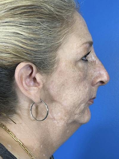 Liquid Rhinoplasty Before & After Gallery - Patient 135005 - Image 2