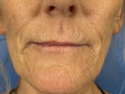 Cool Peel Before & After Gallery - Patient 403977 - Image 1