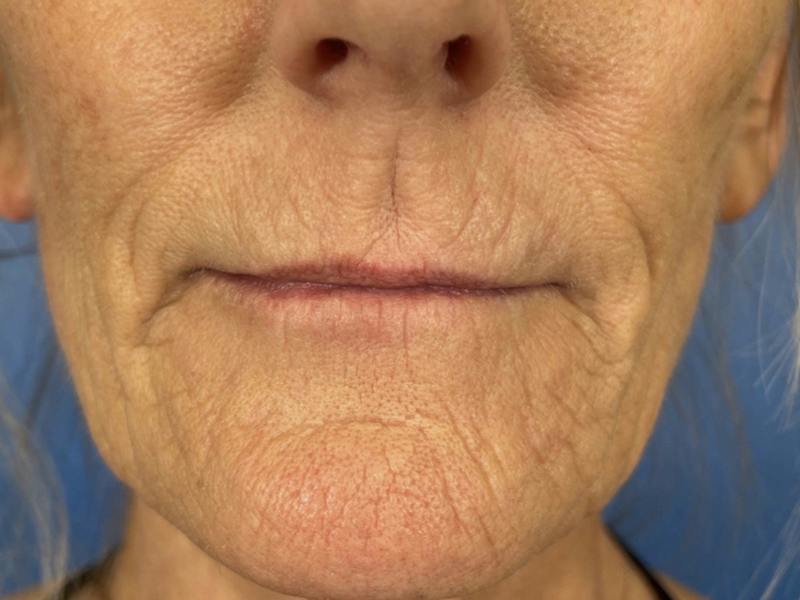 Cool Peel Before & After Gallery - Patient 403977 - Image 1