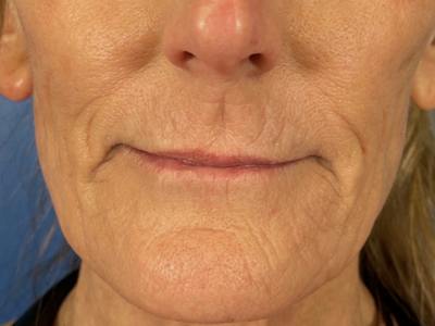 Cool Peel Before & After Gallery - Patient 403977 - Image 2