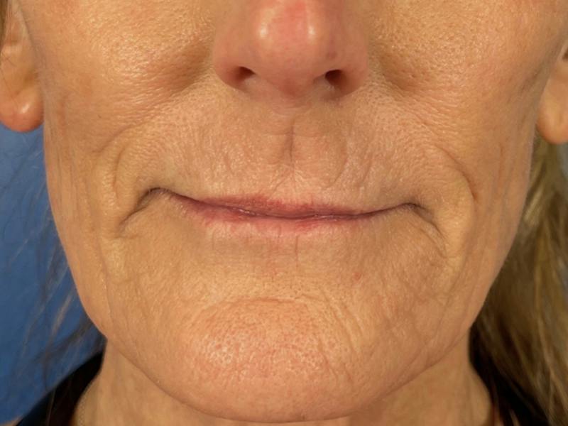 Cool Peel Before & After Gallery - Patient 403977 - Image 2