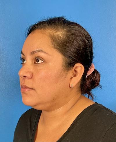 Chin Liposuction Before & After Gallery - Patient 406699 - Image 1