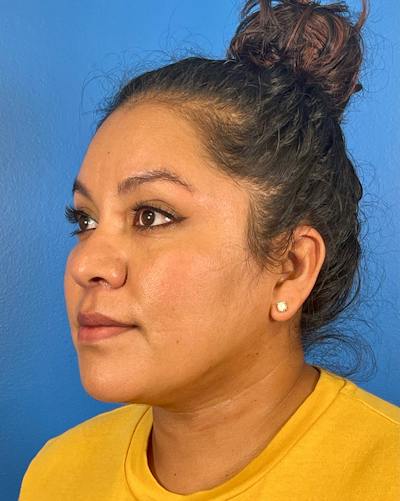 Chin Liposuction Before & After Gallery - Patient 406699 - Image 2