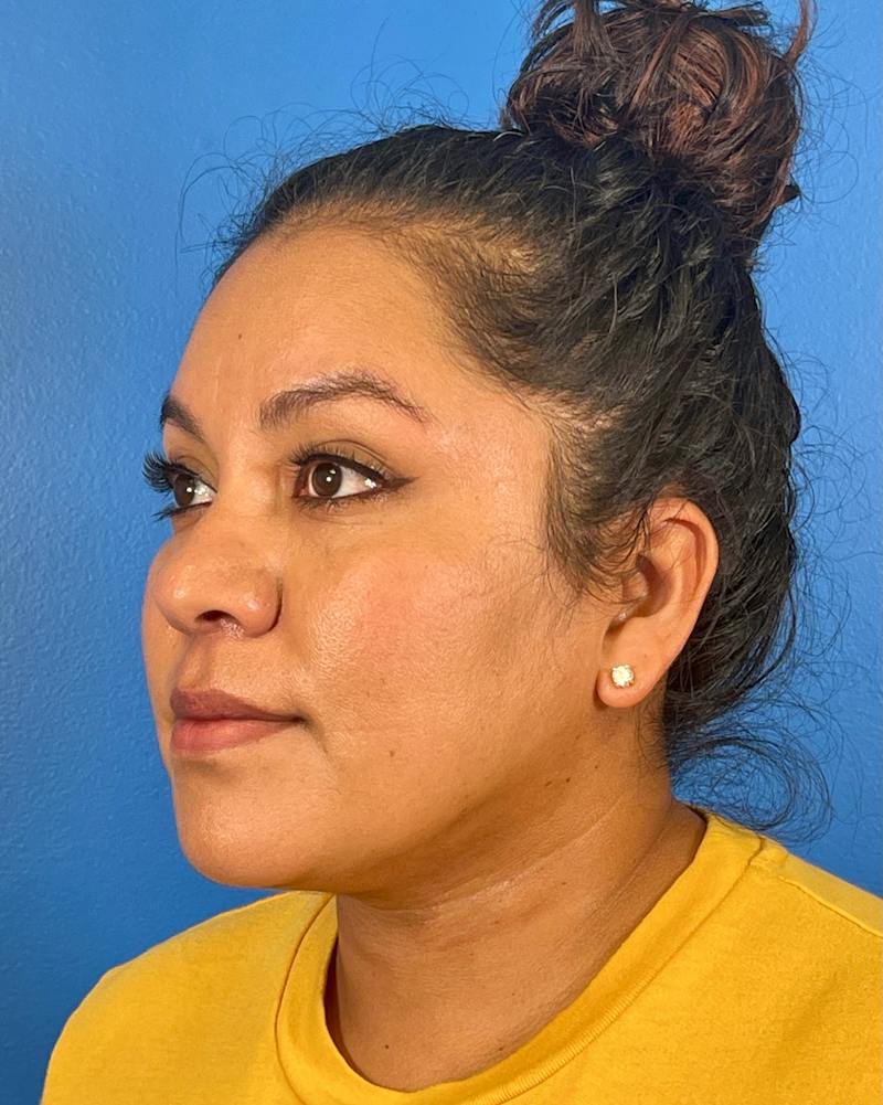 Chin Liposuction Before & After Gallery - Patient 406699 - Image 2