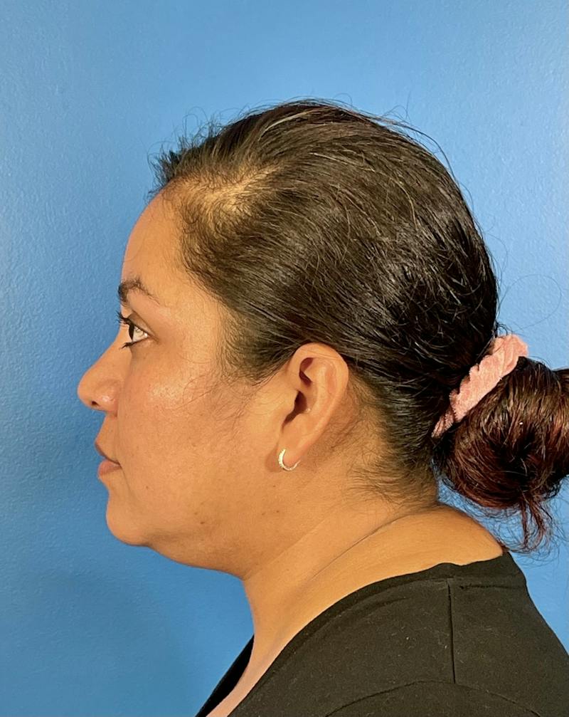 Chin Liposuction Before & After Gallery - Patient 406699 - Image 3