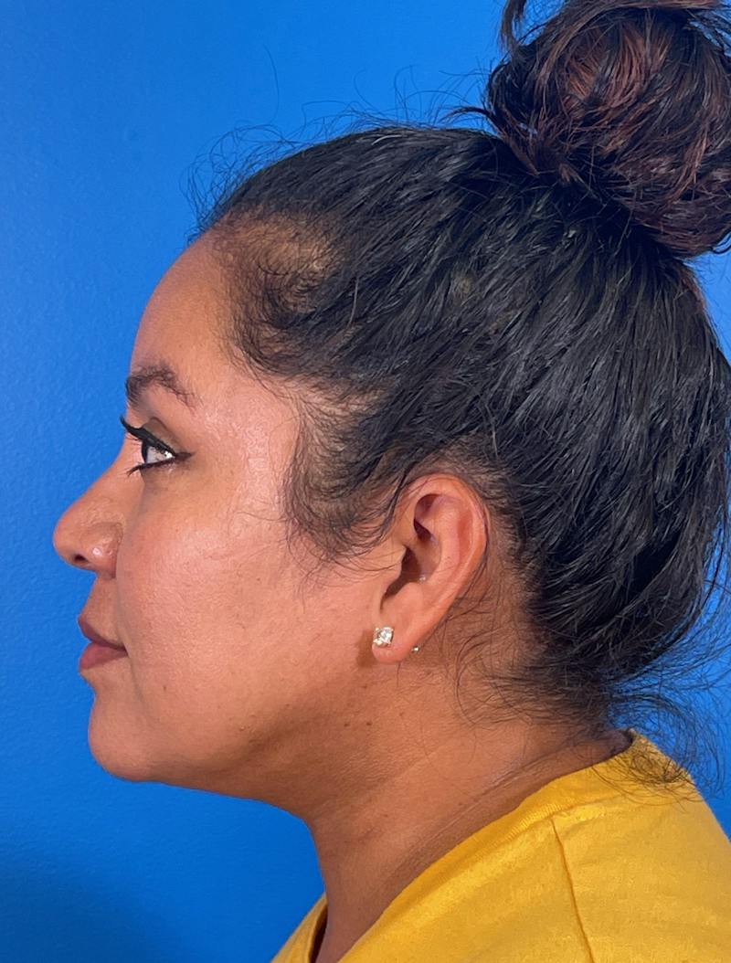 Chin Liposuction Before & After Gallery - Patient 406699 - Image 4