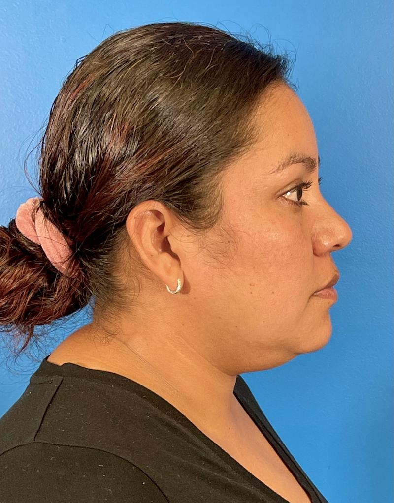 Chin Liposuction Before & After Gallery - Patient 406699 - Image 5