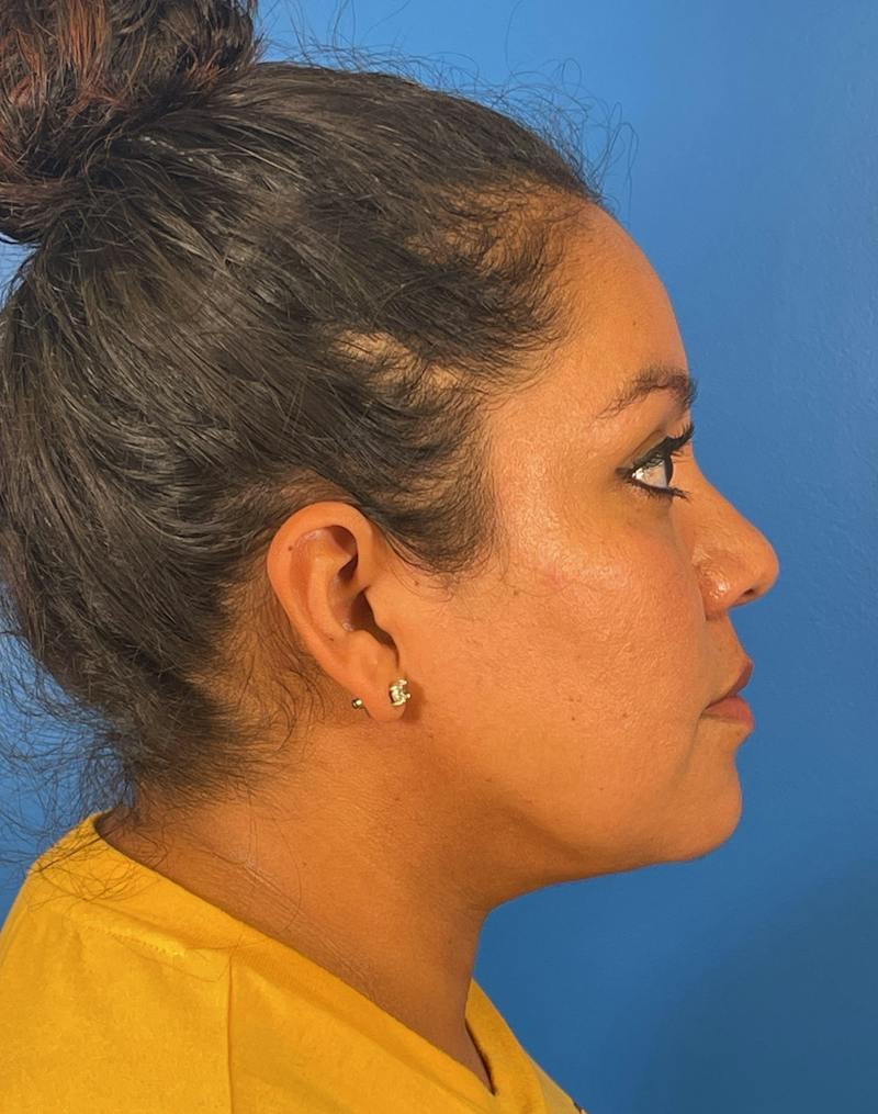 Chin Liposuction Before & After Gallery - Patient 406699 - Image 6