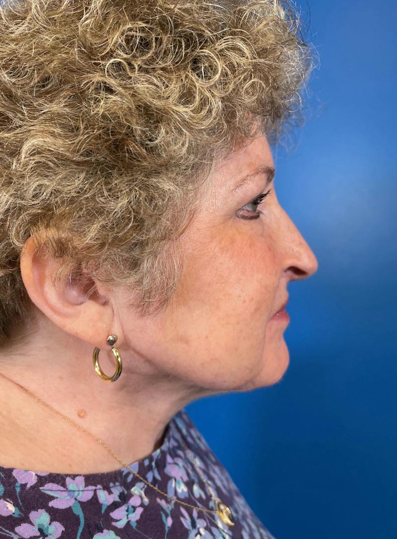 Chin Liposuction Before & After Gallery - Patient 150502 - Image 2