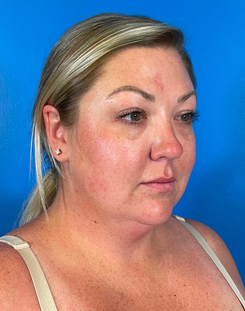 Chin Liposuction Before & After Gallery - Patient 247806 - Image 7