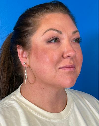 Chin Liposuction Before & After Gallery - Patient 247806 - Image 2