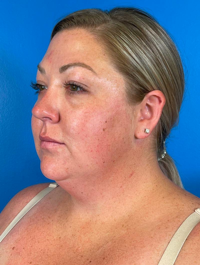 Chin Liposuction Before & After Gallery - Patient 247806 - Image 5