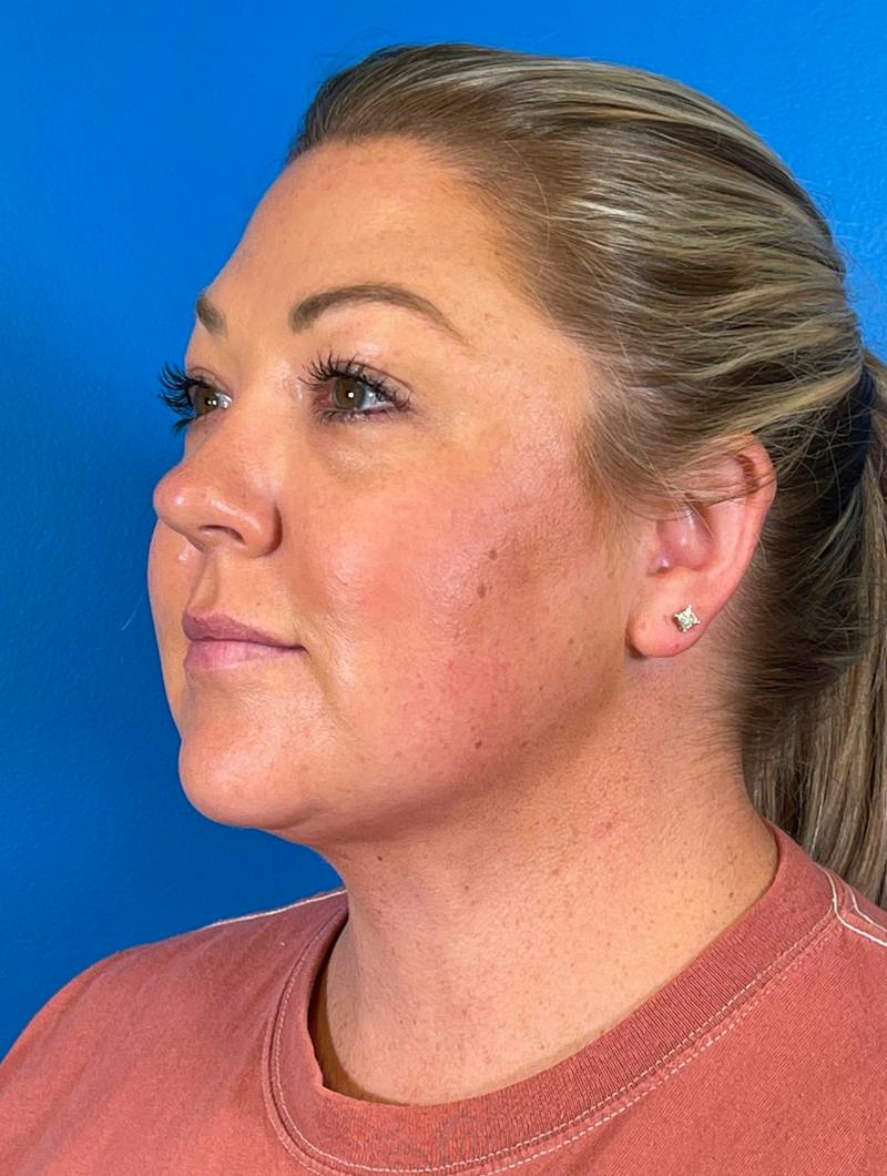 Chin Liposuction Before & After Gallery - Patient 247806 - Image 10