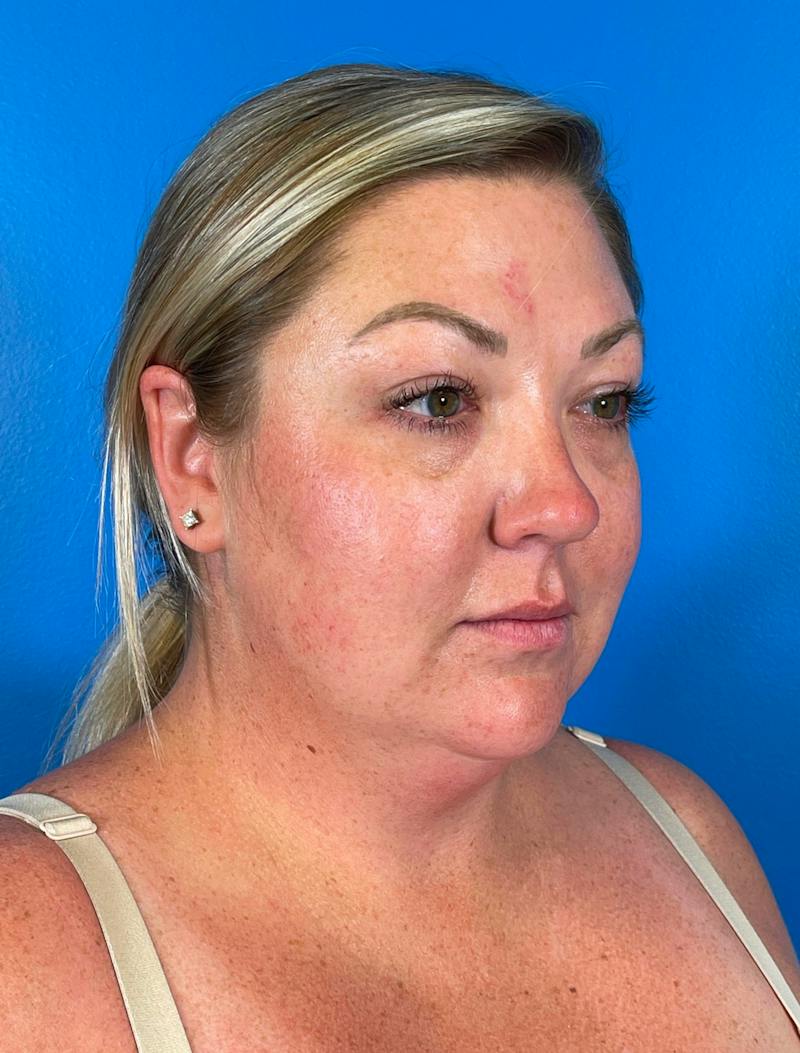 Chin Liposuction Before & After Gallery - Patient 247806 - Image 1