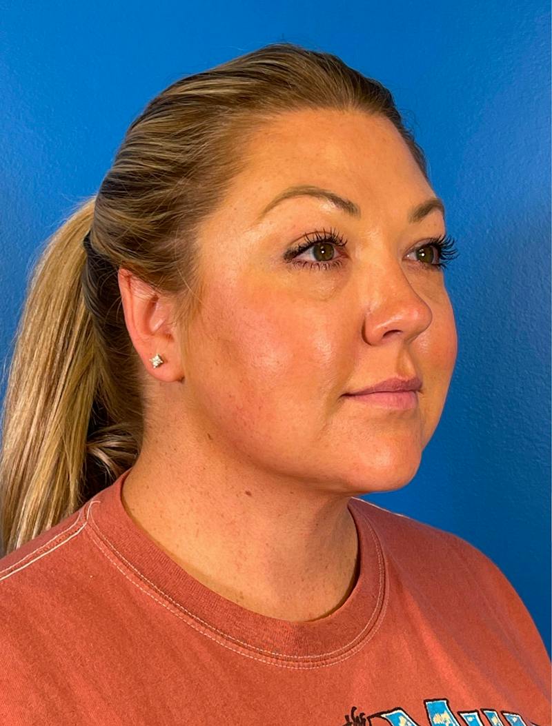 Chin Liposuction Before & After Gallery - Patient 247806 - Image 8