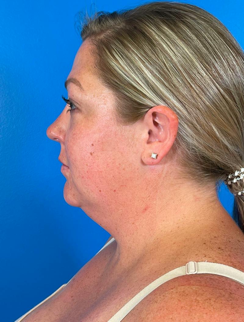 Chin Liposuction Before & After Gallery - Patient 247806 - Image 3