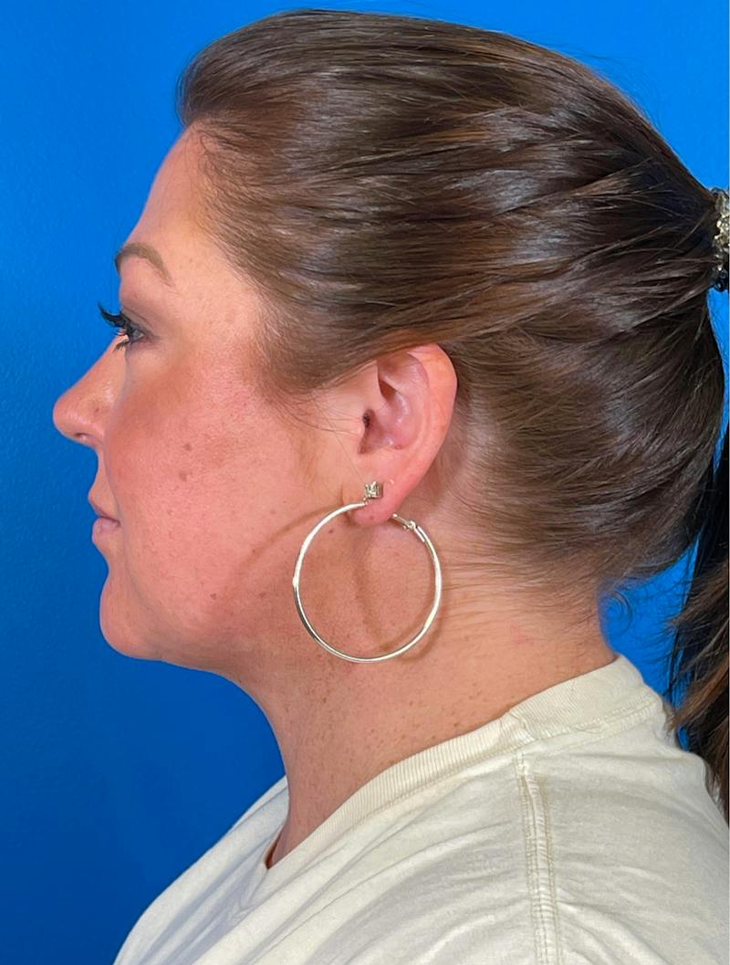 Chin Liposuction Before & After Gallery - Patient 247806 - Image 4