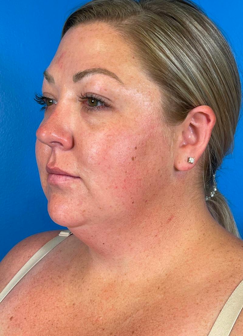 Chin Liposuction Before & After Gallery - Patient 247806 - Image 9
