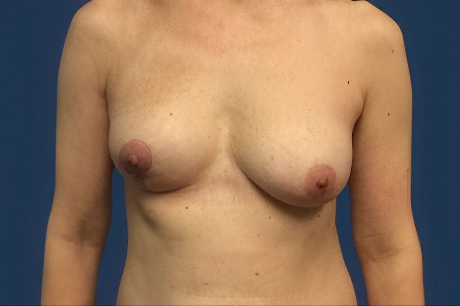 Patient 22309 | Front View | Before — Dr. Tommaso Addona -