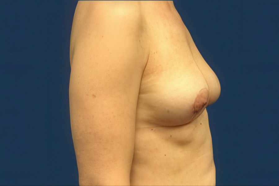 Patient 22309 | Profile View | Before — Dr. Tommaso Addona -