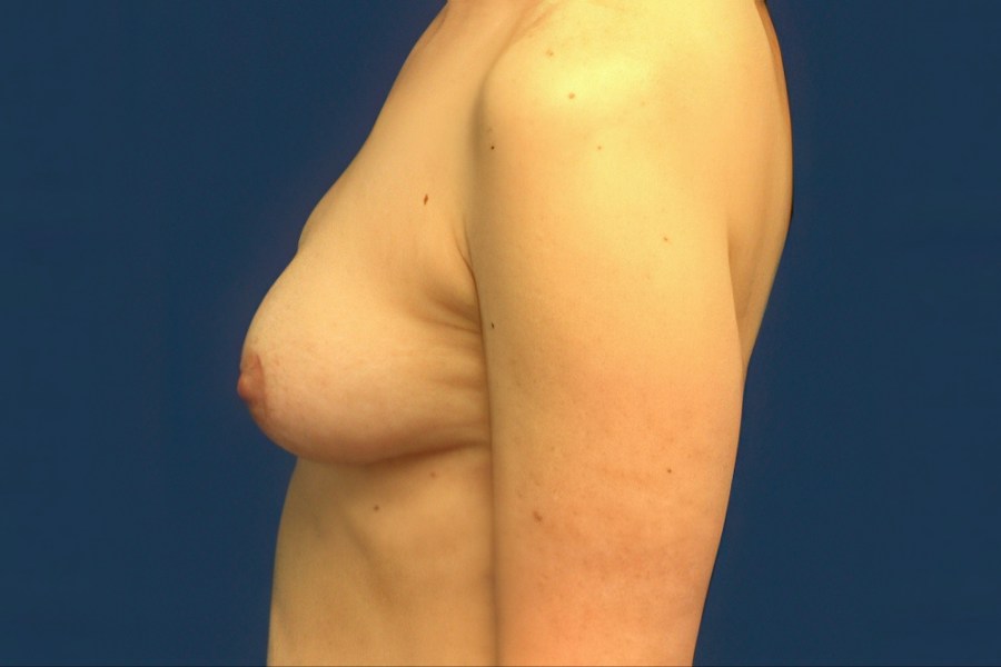 Patient 22309 | Profile View | Before — Dr. Tommaso Addona -