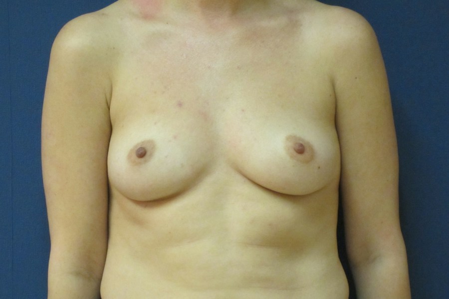 Patient 13604 | Front View | Before — Dr. Tommaso Addona -