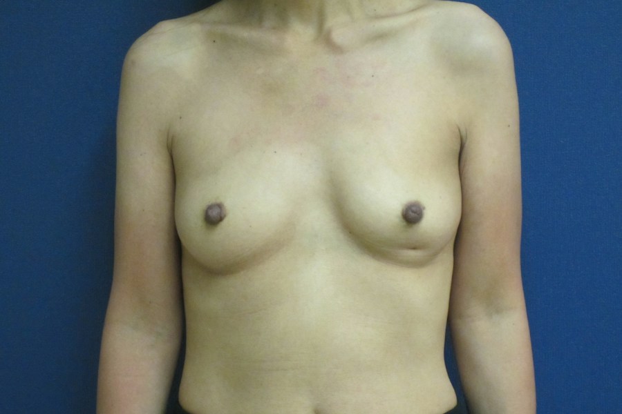 Patient 13600 | Front View | Before — Dr. Tommaso Addona -