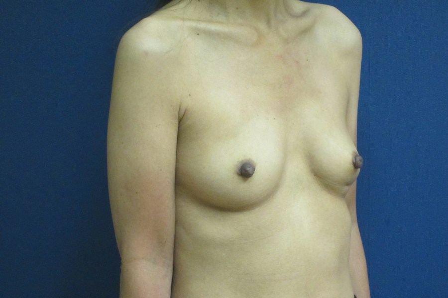 Patient 13600 | Angle View | Before — Dr. Tommaso Addona -