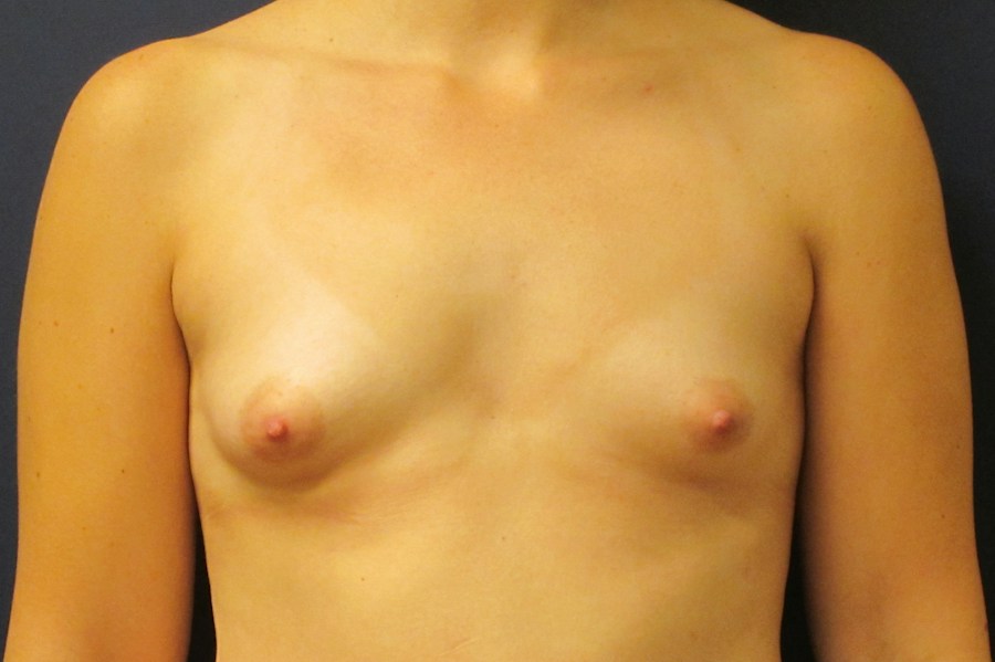 Patient 16090 | Front View | Before — Dr. Tommaso Addona -