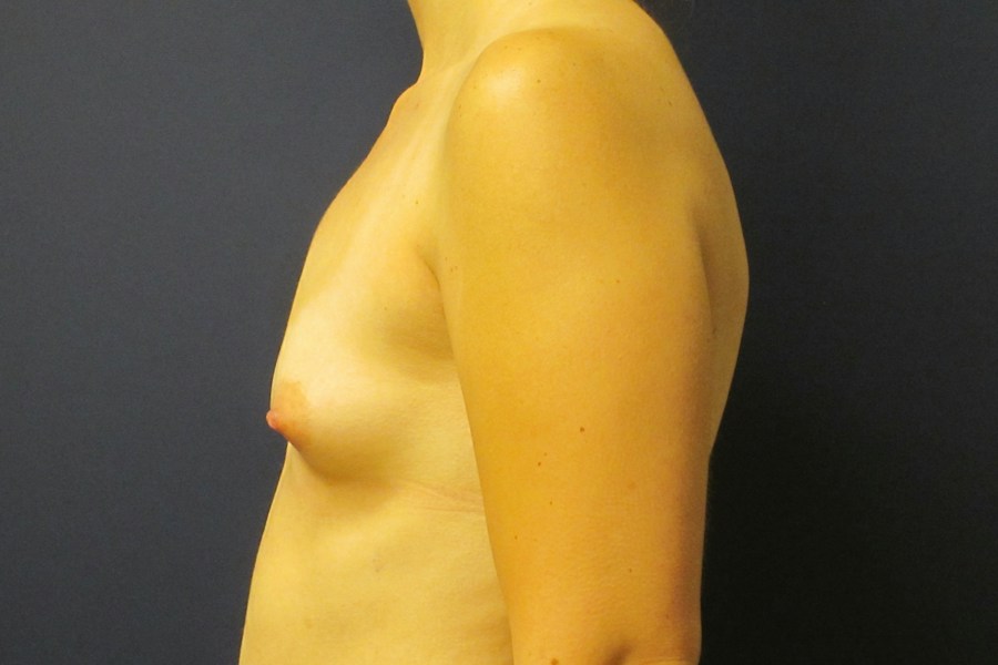 Patient 16090 | Profile View | Before — Dr. Tommaso Addona -