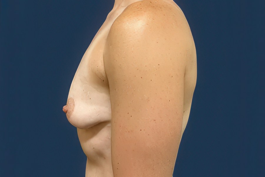 Patient 67891 | Profile View | Before — Dr. Tommaso Addona -