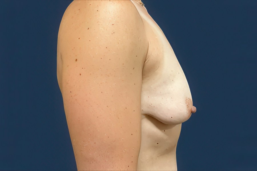 Patient 67891 | Profile View | Before — Dr. Tommaso Addona -