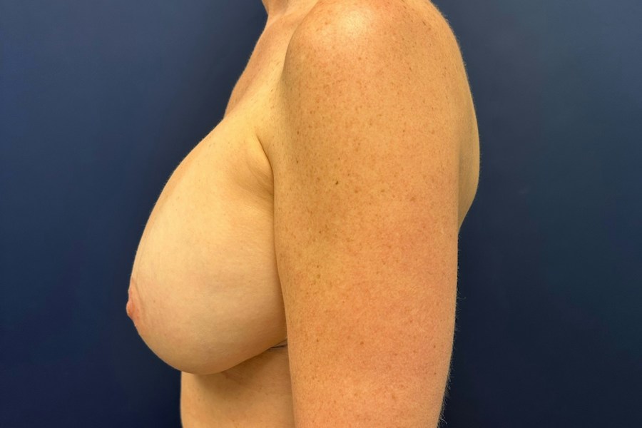 Patient 52835 | Profile View | After — Dr. Tommaso Addona -