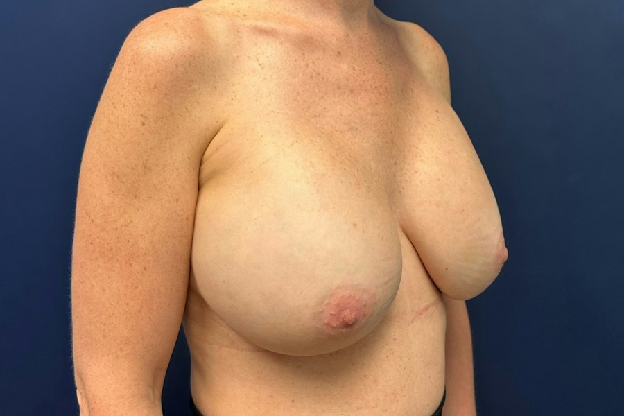 Patient 52835 | Angle View | After — Dr. Tommaso Addona -