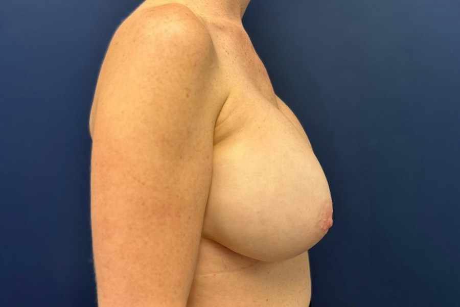 Patient 52835 | Profile View | After — Dr. Tommaso Addona -