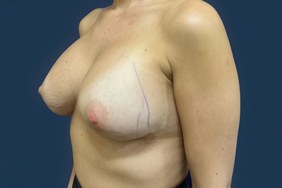 Patient 52056 | Angle View | After — Dr. Tommaso Addona -