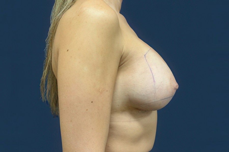 Patient 52056 | Profile View | After — Dr. Tommaso Addona -