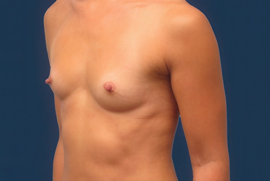 Patient 50228 | Angle View | Before — Dr. Tommaso Addona -