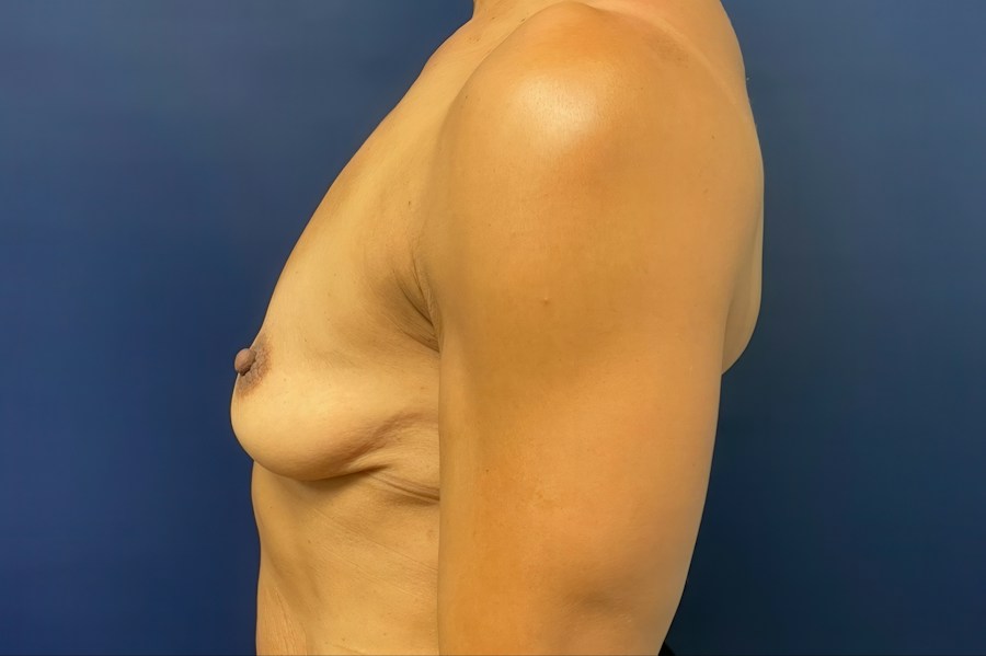 Patient 46680 | Profile View | Before — Dr. Tommaso Addona -