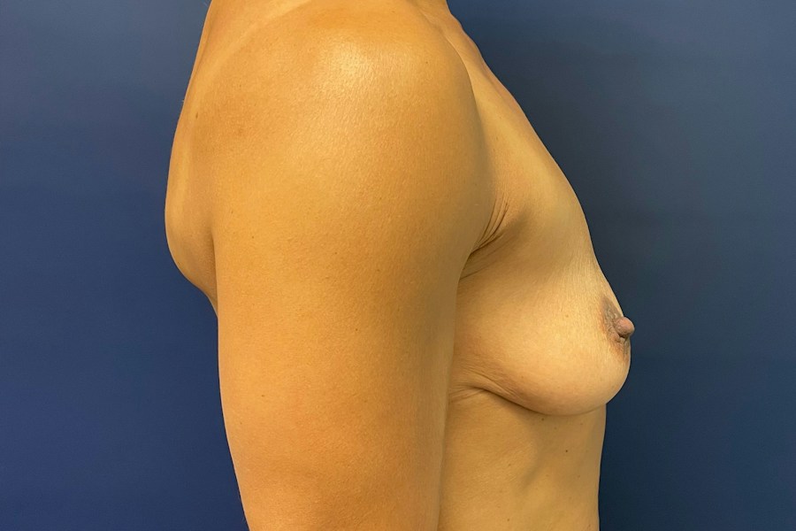 Patient 46680 | Profile View | Before — Dr. Tommaso Addona -